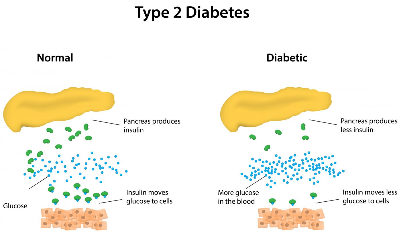 Type 1 diabetes – nhs choices