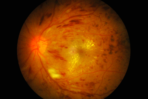 New Diabetic Macular Edema Therapy To Be Tested In First Human Trials