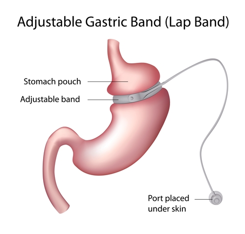 Gastric Bypass Better than Banding for Type 2 Diabetes Management