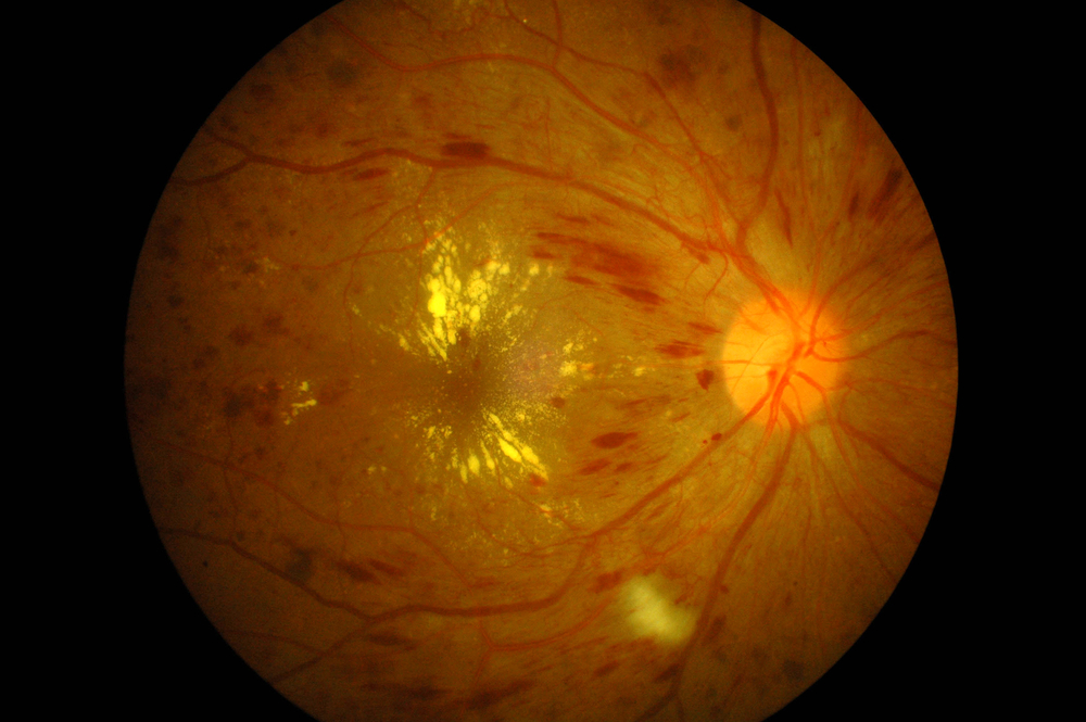 New Diabetic Retinopathy Treatment Gets FDA “Breakthrough Therapy” Approval