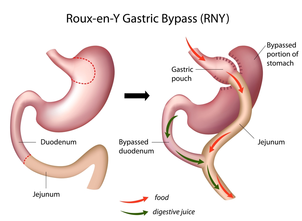 Roux-en-Y Gastric Bypass Positively Impacts Patients’ Metabolomic and Lipidomic Profile
